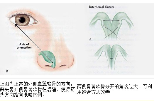 臺灣風華蒜頭鼻治療