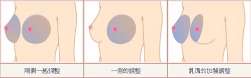 玻尿酸隆胸